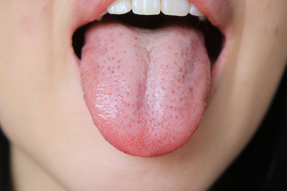 フレイル予防に「舌圧トレーニング」　フレイルのサインは「口の中」に表れる？